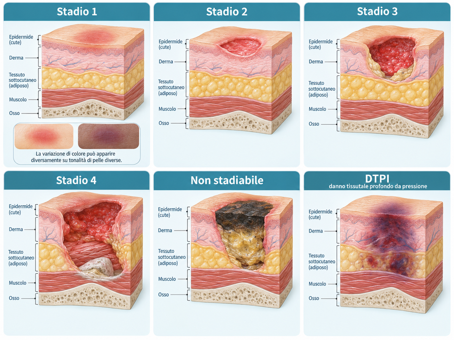 Infografica clinica in sei riquadri che mostra in sezione Stadio 1, Stadio 2, Stadio 3, Stadio 4, lesione non stadiabile e danno tissutale profondo da pressione.