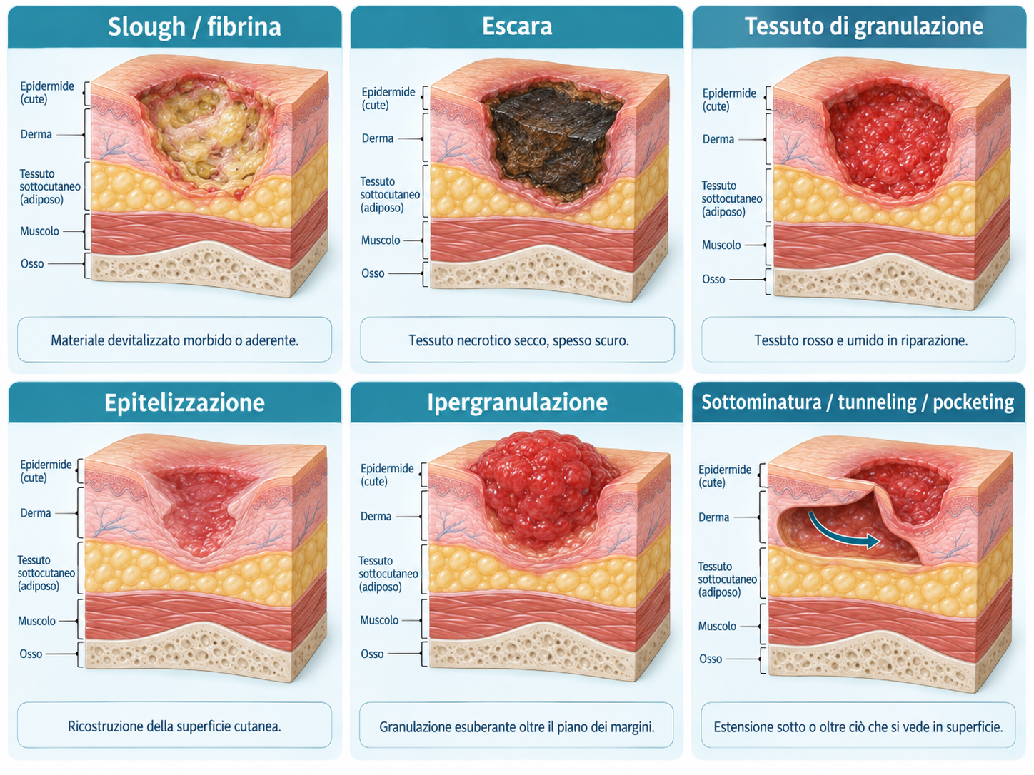 Infografica clinica in sei riquadri che illustra slough o fibrina, escara, tessuto di granulazione, epitelizzazione, ipergranulazione e sottominatura o tunneling.